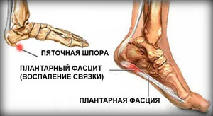 Доказан традиционните средства за лечението на петата шпорите