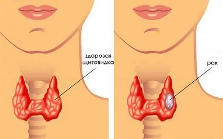 Симптомите на заболяване на щитовидната жлеза първите симптоми при жените и мъжете
