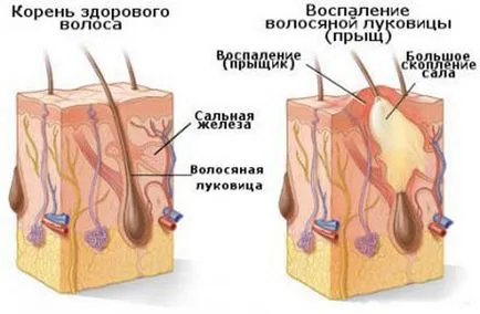 От това, което пъпки - по лицето, гърба, челото, папата, на езика, на главата, ръцете, подкожно
