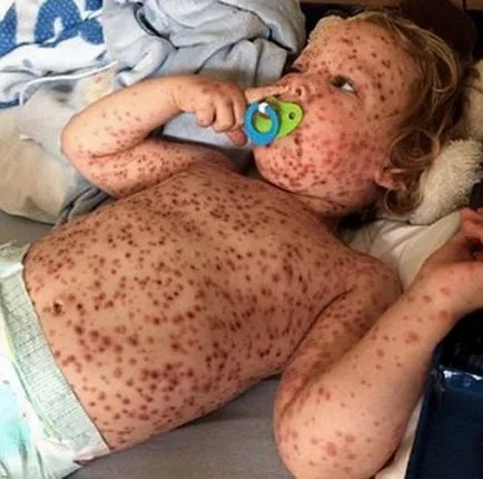 Усложнения от варицела при деца на последиците от варицела, която може да бъде усложнения при деца под