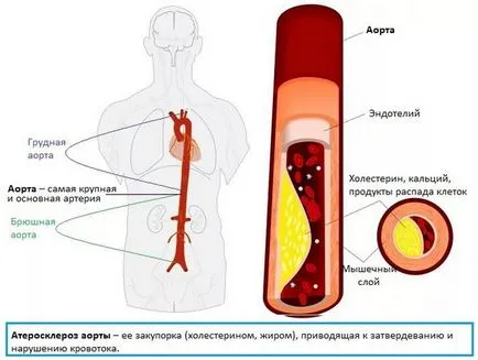 Склероза на аортата, която е, причините, симптоми, лечение (симптоми) Склероза на аортата т.е. причини, симптоми, лечение