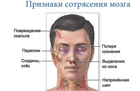 Сътресение симптоми, последствия, лечение