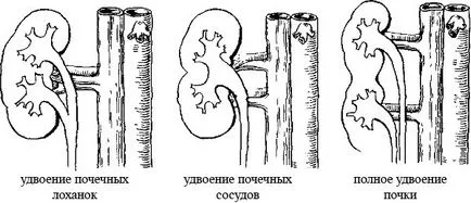 Удвояването на бъбреците води, усложнения, лечение (причини) Удвояването на бъбреците причини усложнения, лечението