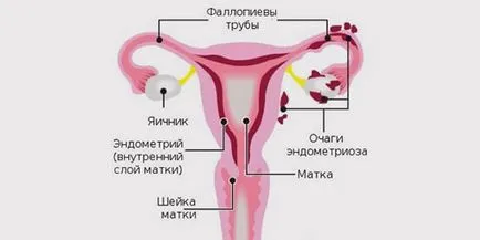 Узи ендометриума може да се види дали ендометриоза, полипи, рак, ендометриоза (ендометриум) Узи ендометриума може да се види дали ендометриоза, полипи, рак, ендометрит