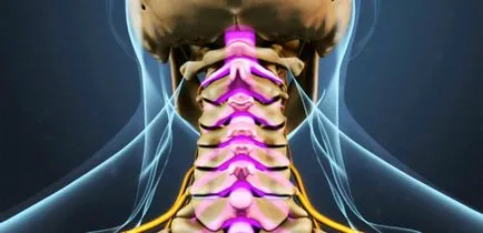 вертеброгенни cervicalgia