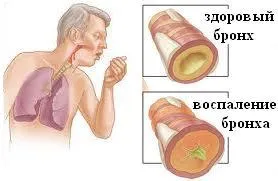 Хроничен бронхит Симптоми и лечение при възрастни