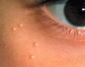 Уен да се изправи на причините за възникване и лечение
