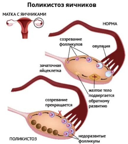Поликистоза и билки, които е най-добре за лечение на поликистозните яйчници, бъбреци, билки за събиране
