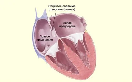 аневризма WFP