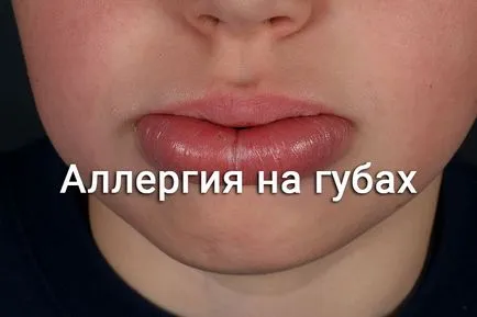 Алергии в хейлит на устните, къде и как да се отнасяме