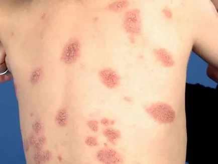 Алергичен обрив при деца изглежда като на снимката, различни видове алергии върху кожата, симптоми и лечение