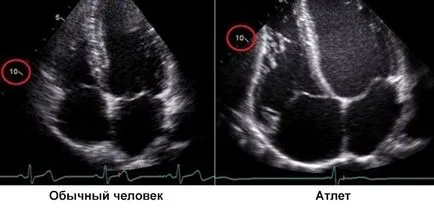 Big сърцето причинява, диагностика, лечение и прогноза на заболяването