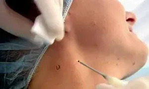 Какво е диспластични невуси, видове, причини, лечение