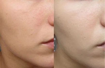 Дарсонвализация Face Как е процедурата, показания и противопоказания, мнения на изпитание