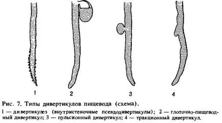 хранопровода дивертикул, симптоми и лечение