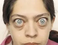 Exophthalmos - причини, симптоми, диагностика и лечение