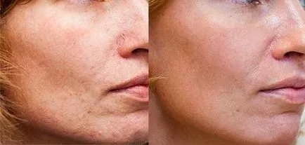 Fraxel (Fraxel) - фракционна фототермолиза, подмладяване на лицето лазер - какво е това, цени,
