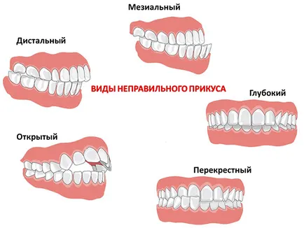 Захапка как да се определи преди и след третиране на снимки (правилно) Захапка как да се определи преди и след третиране на снимки
