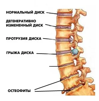 Дискова херния, информация за симптомите, диагностиката и лечението