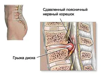 Дискова херния, информация за симптомите, диагностиката и лечението