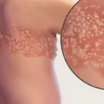 Pink лиши снимка на детето и лечение на признаци и симптоми