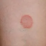 Pink лиши снимка на детето и лечение на признаци и симптоми