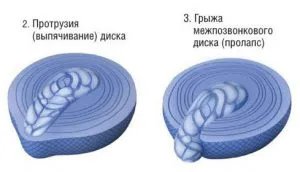Дали гръбначния диск издатина лечима