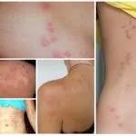 Как да се отървем от дървеници в дивана у дома
