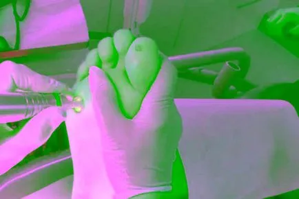Как да се отървете от брадавици дом и медицински методи