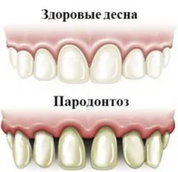 Как за лечение на пародонтит в дома лекарствата от народната медицина 1