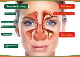 Как за лечение на синузит народни средства