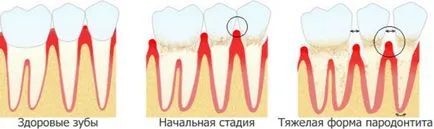 Как за лечение на пародонтит в дома лекарствата от народната медицина 1