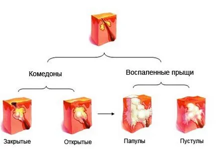 Как да се отървете от акне нощ (акне) Как да се отървете от пъпки на вечер
