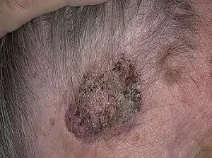 Seborrheic кератоми причини и съвременни методи на лечение (себореен Кератомни лечение на народната медицина.) Себореен кератоми причини и съвременни методи на лечение
