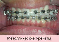 Колко е цената на лечението на корекция захапка