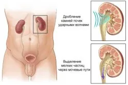 Камъни в бъбреците - какво да правят, на първо място