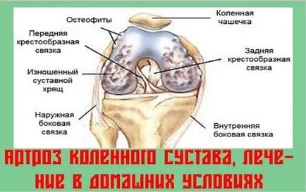Лечение на остеоартрит на коляното народната отстранява