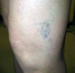 разширени вени лечение на народната медицина у дома