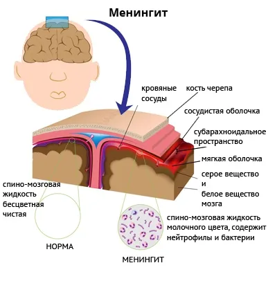Менингитът е заразен или не, както е докладвано, рискови фактори (фактори) Менингитът е заразен или не, както е докладвано, рискови фактори