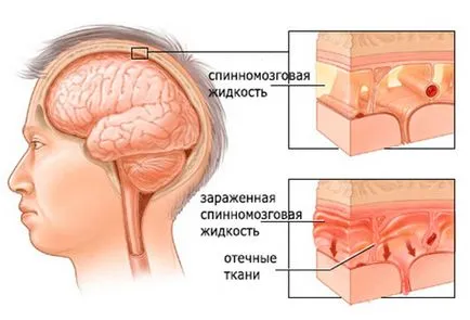 Менингитът е заразен или не, както е докладвано, рискови фактори (рискови) Менингитът е заразен или не, както е докладвано, рискови фактори