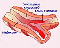 Муковисцидоза - причини, симптоми, диагностика и лечение (диагностика) Муковисцидоза - причини, симптоми, диагностика и лечение