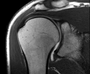 MRI на раменната става, че може да се открие, като се направи диагностика (съвместно) MRI на раменната става, че може да се открие, както и намирането на диагностиката