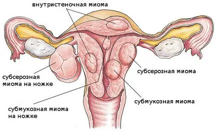 Нехомогенни миометриума на каква заболявания поставят диагноза