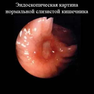 Улцерозен колит симптоми, лечение, прогноза (неспецифичен) Язвен колит симптоми, лечение, прогноза