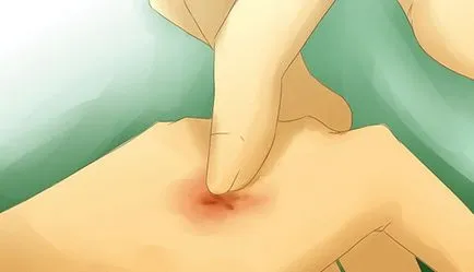 Mosquito ухапване премахване на отоци, лечение и грижи за деца