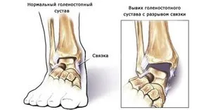 Особено консервативен и национално третиране глезена след навяхване (глезен) Особено консервативна и национално третиране глезена след навяхване
