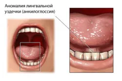 юздичка на езика
