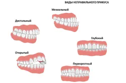 юздичка на езика