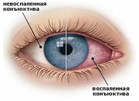 Възпаление на лечение на очите и профилактика