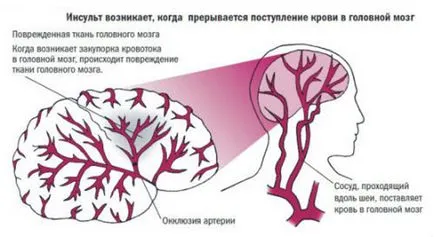 Причините за инсулт - обичат произтича от това, което се случва при жените, мъжете, млад